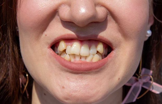 What is dental crowding?